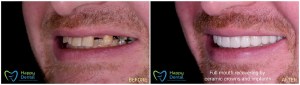 Smile before and after full mouth crowns and implants